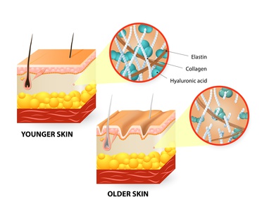 Aging skin diagram-Hyaluronic Acid declines with age