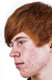 Teen male with acne